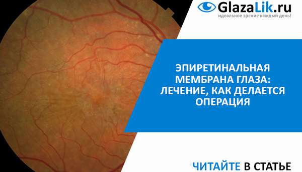 Лечение эпиретинальной мембраны глаза